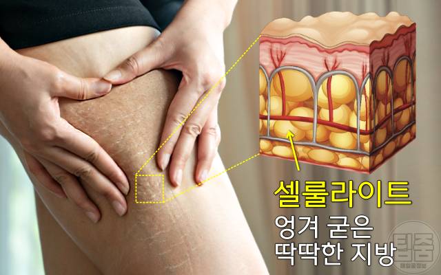 허벅지 셀룰라이트 제거 운동 허벅지 셀룰라이트 제거 방법 셀룰라이트란?