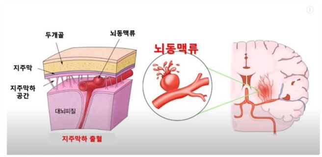 뇌동맥류 증상