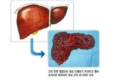 B형 간염 증상