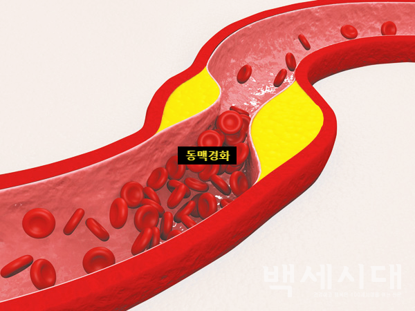 초음파 조영검사 비용이 많이 드는 음식에 대해 동맥경화 증상 관상동맥 질환의 원인으로