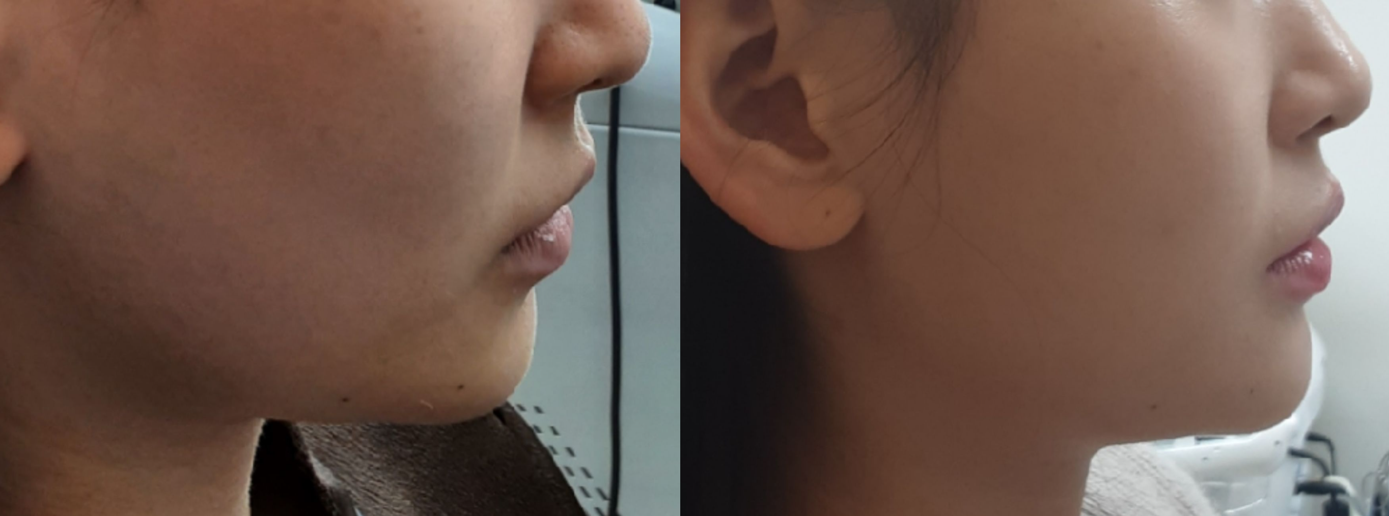  울쎄라 몇살부터?