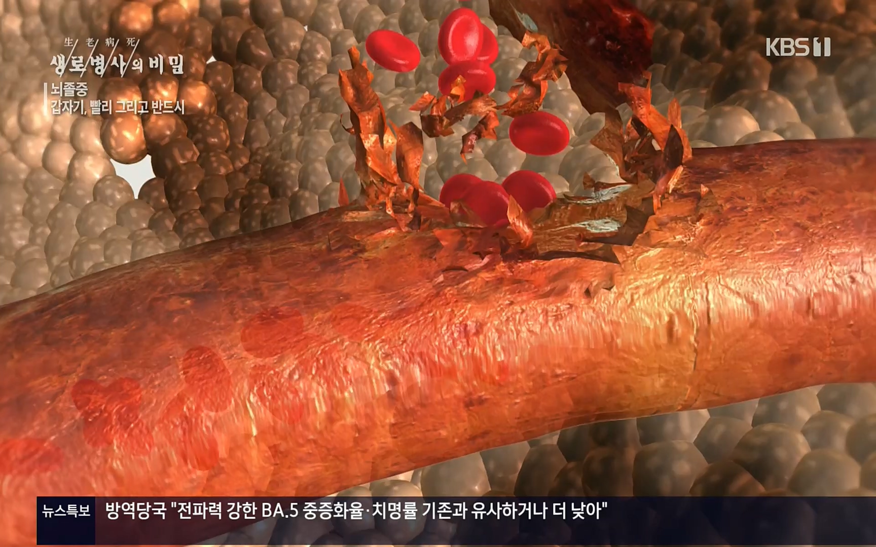 생로병사의 비밀.E835p.H264-F1RST.mp4_20220917_181733.572.jpg