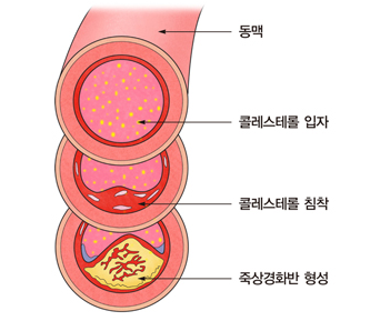 콜레스테롤