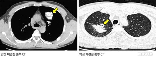  흉부 X-ray/CT 영상 분석을 통한 폐암 진단 알고리즘 - 폐종양과 폐결절