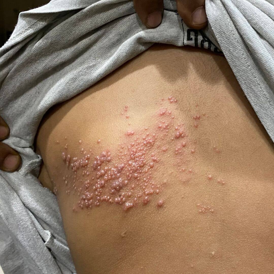 대상포진 격리 필요할까 전염성에 대한 오해와 진실