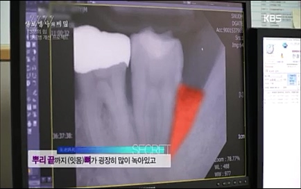 [670회] 생로병사의 비밀 - KBS670회] 생로병사의 비밀.ts_20220505_141927.094.jpg