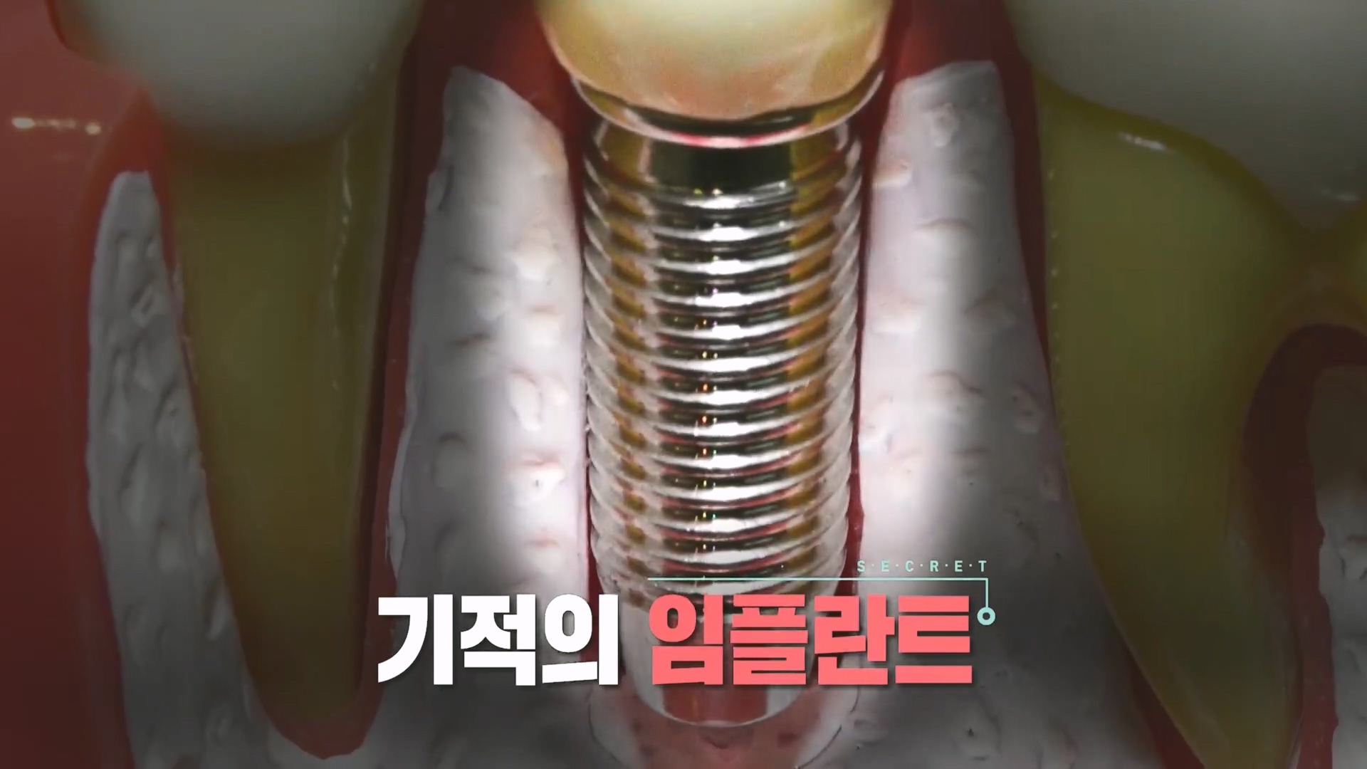 생로병사의 비밀.E890.231213p.H264-F1RST.mp4_20231214_195009.181.jpg