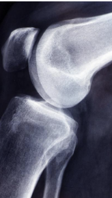 무릎 십자인대 파열 증상