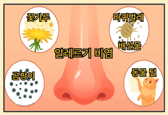 갑자기 맑은 콧물이 흐르는 이유 - 알레르기 비염