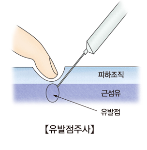 섬유근육통 유발점주사