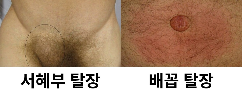 탈장-종류