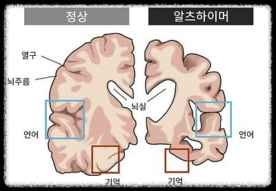 콜라겐과 알츠하이머의 상관관계: 과학적 근거와 이해하기 쉬운 사례