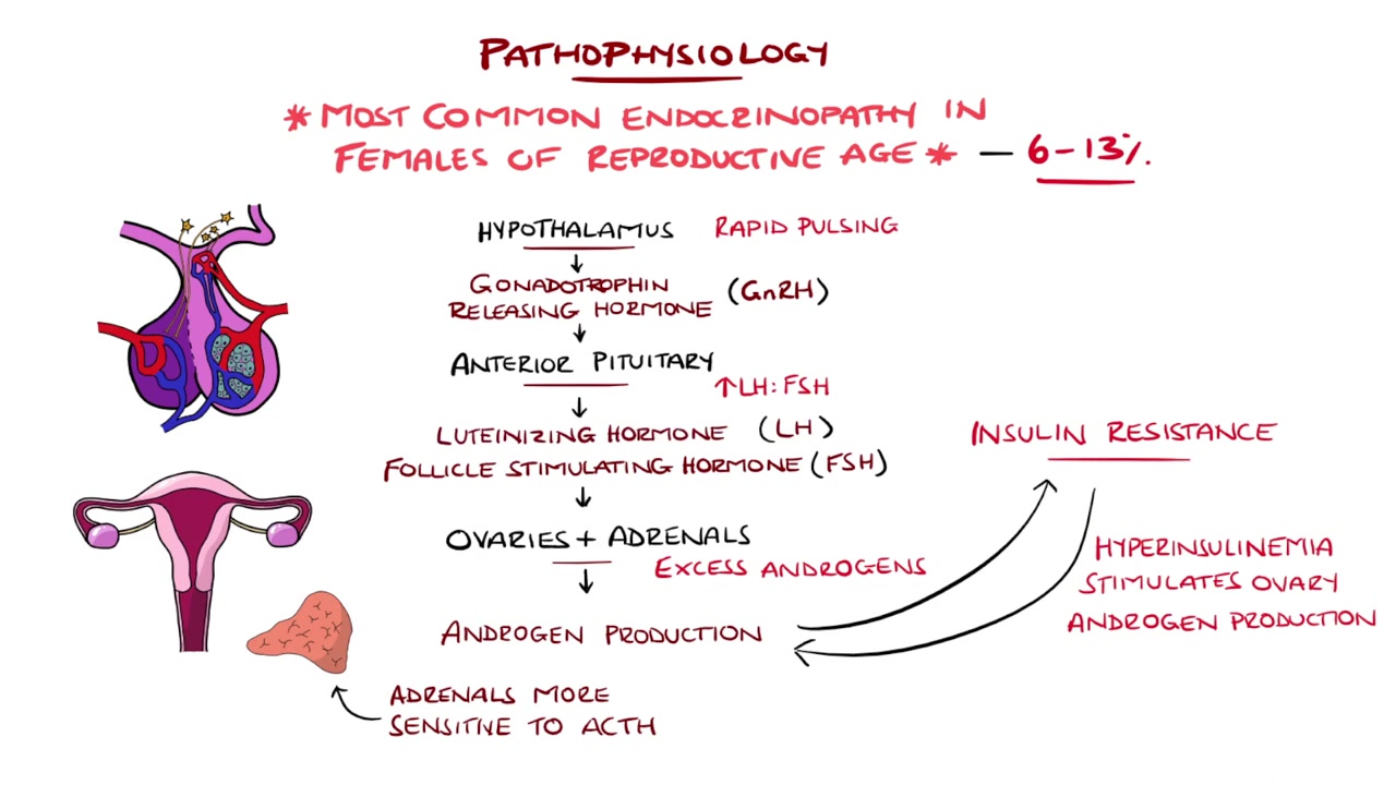 다낭성 난소 증후군에 대한 쉬운 설명(PCOS : Polycystic Ovary Syndrom)