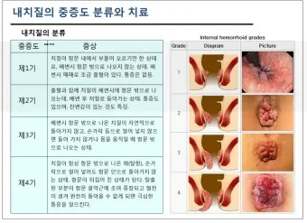 항문가려움 원인 치료방법 관리방법_1