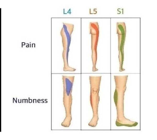 좌골신경통 증상