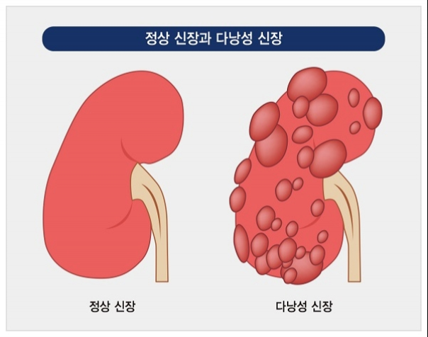 신장이 안좋으면 나타나는 증상 3