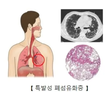폐섬유증 초기 증상 치료법 관리방법_29