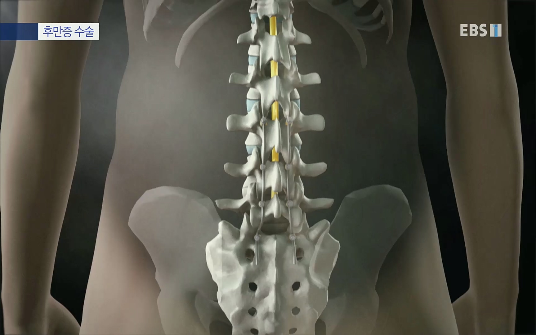 EBS 명의 헬스케어 - TV - 교육의 중심 EBS명의 15년 - 허리통증을 잡아라!.mp4_20220805_210307.493.jpg