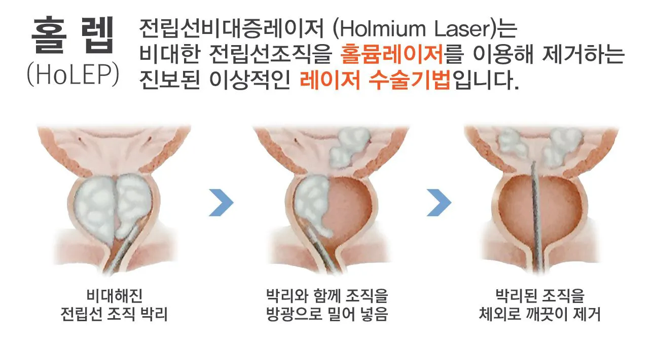 전립선비대증 증상