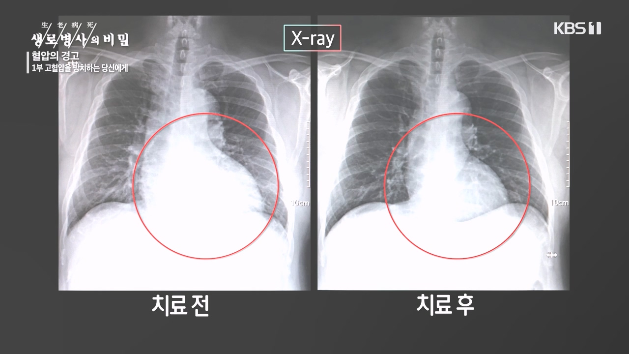 생로병사의 비밀.E887.231026p-NEXT.mp4_20231026_203156.443.jpg