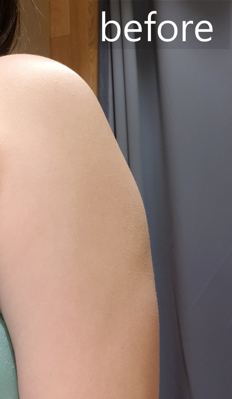 좋네요. 2회차 후기 지방분해주사 팔뚝살빼기 딱 9