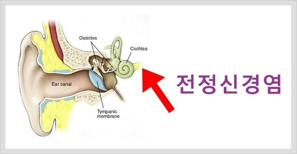 전정신경염 증상