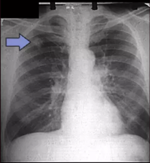 solitary_pulmonary_nodule_X-ray