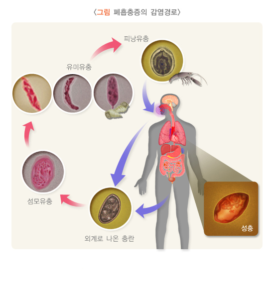  폐흡충증