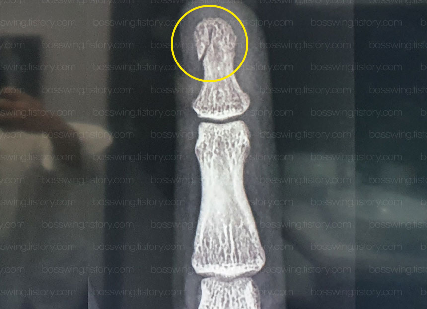  손가락 끝 뼈 골절 부러짐, 어느날 갑자기 손톱이 빠짐?! 현관문 속도 조절 방법