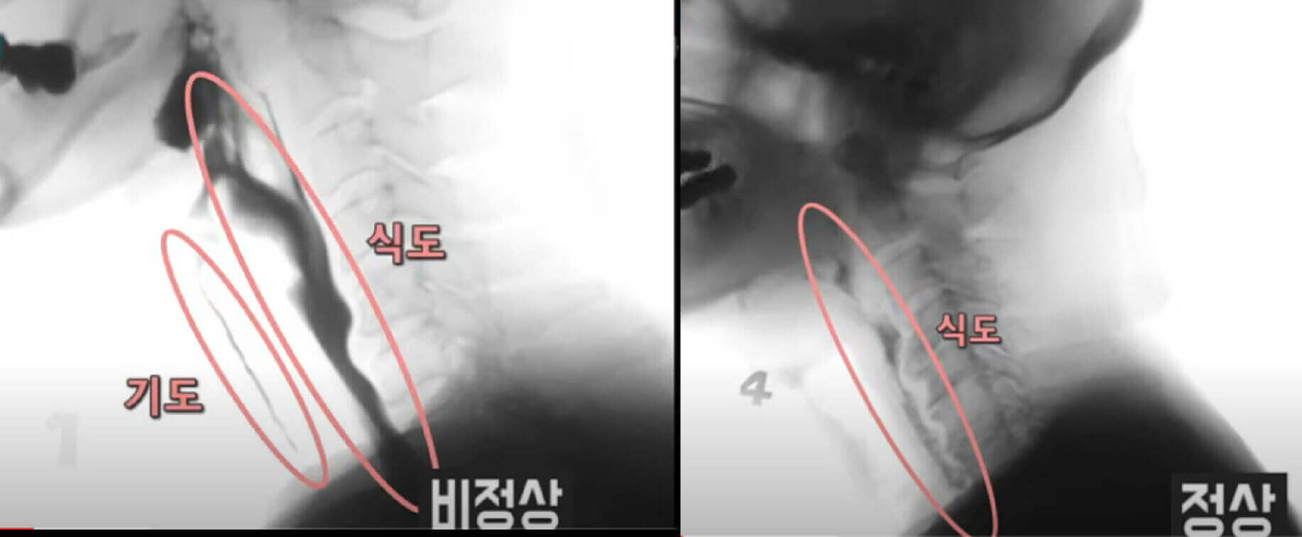  생존에 아주 중요한 호흡근과 삼킴 근육 강화 방법