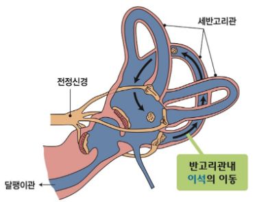 이석증 증상