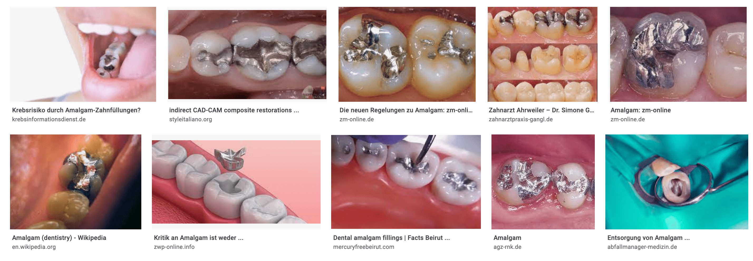 Amalgam (dentistry) - Wikipedia