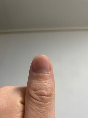  손톱 발톱 검은세로줄 흑색조갑증 증상 및 원인 알아보기