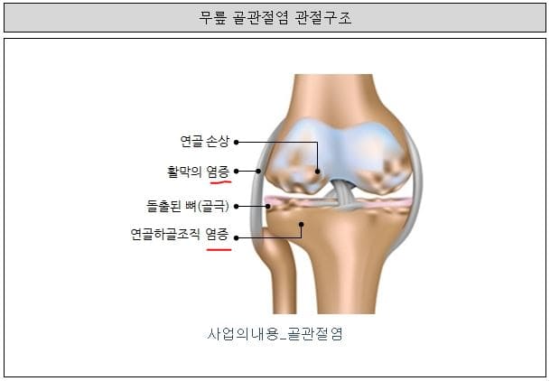 무릎 골관절염 구조