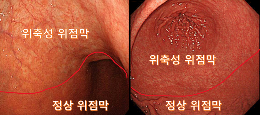 만성 위염의 증상과 치료법은 무엇인가요? 3