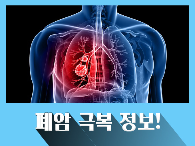  폐암이란? 폐암의 예방방법, 폐암의 진단, 폐암의 치료방법은?