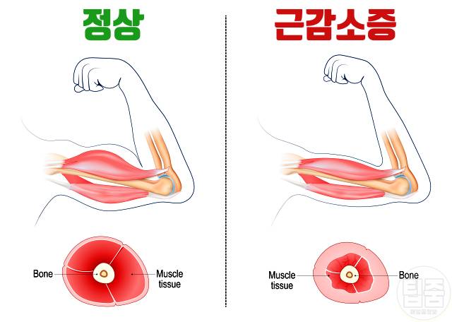 비타민d 결핍 증상 비타민d권장량 근감소증 근력저하