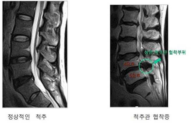 허리 협착증 증상