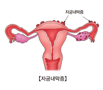 자궁내막증 원인