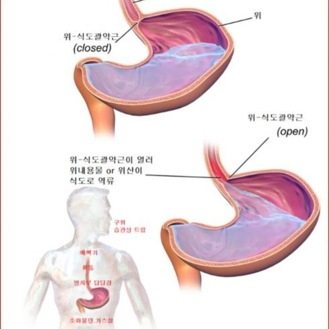 역류성 식도염 증상과 자연치료 방법