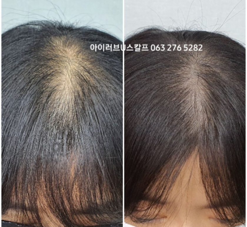  여성 정수리 가르마 산후탈모 전주 두피문신 smp로 해결