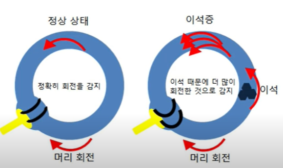 이석증 자가진단 자가치료 방법