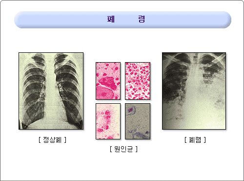 폐렴 증상