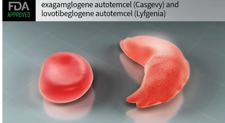 1회 투약 비용이 41억원?: 세계 최고 비싼 약 순위 FDA Approves First Gene Therapies to Treat Patients with Sickle Cell Disease