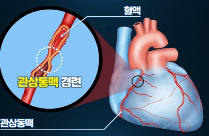 변이형협심증