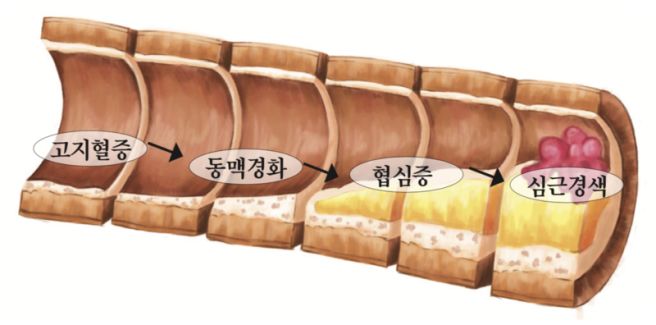 협심증 증상