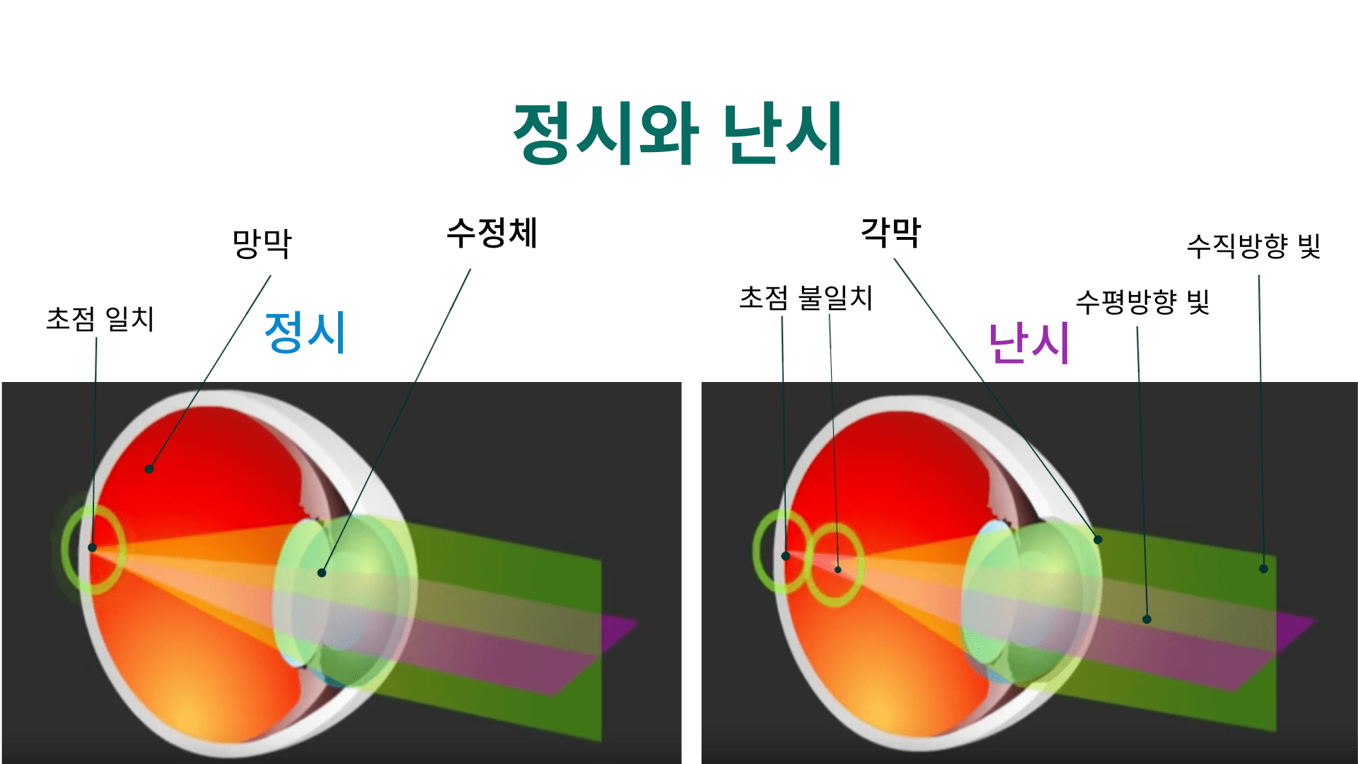 왼쪽 그림은 정상 시력을 보여주며, 빛이 각막과 수정체를 통해 망막에 정확하게 초점을 맞춥니다. 오른쪽 그림은 난시를 나타내며, 각막이 비대칭적이어서 빛이 여러 초점으로 나뉘고 고르게 망막에 닿지 않아 시야가 흐릿하게 보이는 상태를 설명합니다.