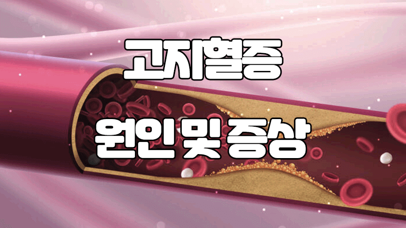  고지혈증 원인 및 증상 : 수치, 이상지질혈증