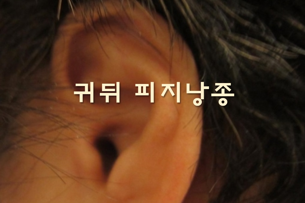  고환 피지낭종과 귀뒤 피지낭종 제거 시술