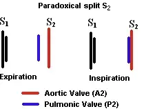 paradoxical split S2
